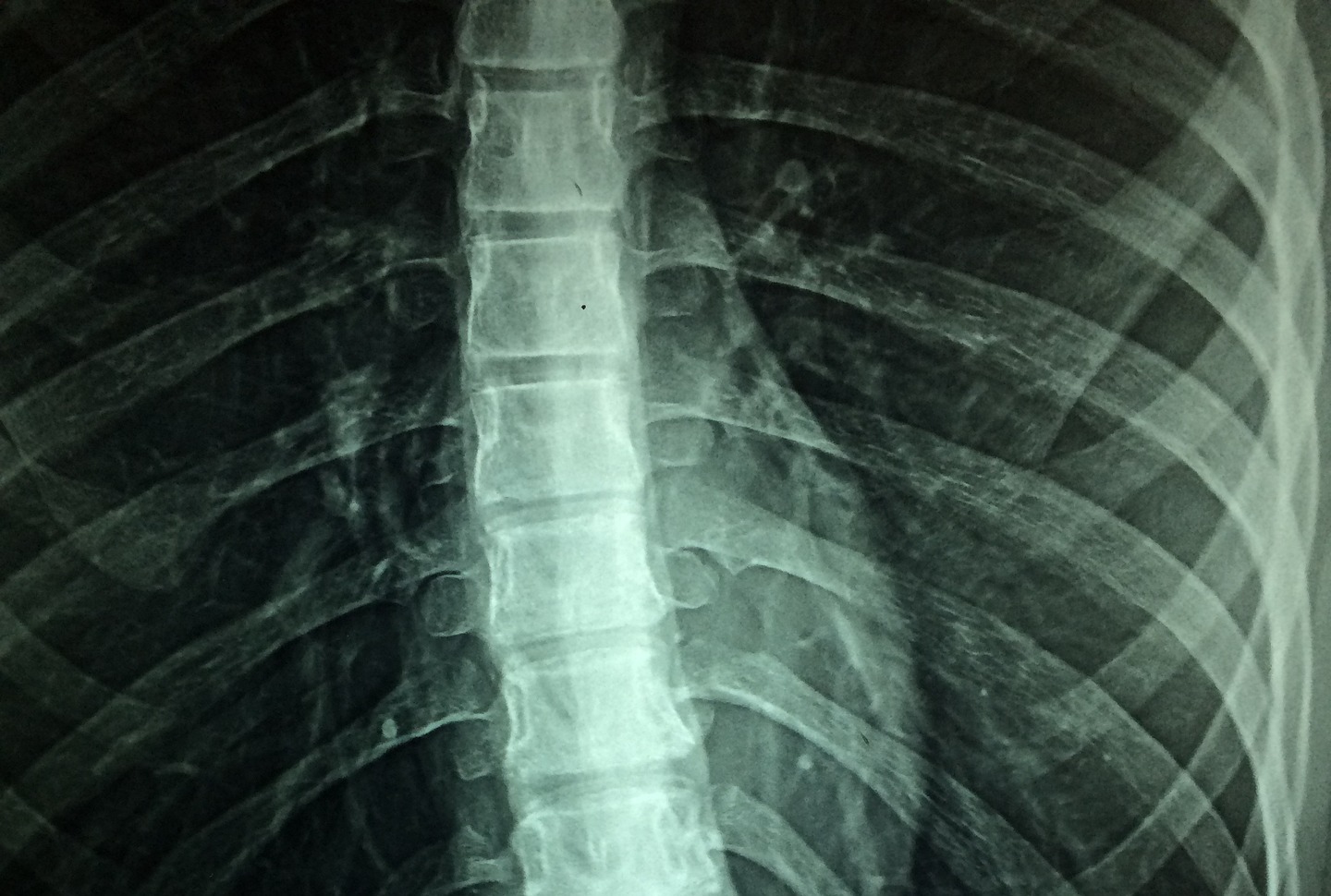 An xray of a person’s spine- our medical negligence compensation solicitors can help you make a no win no fee claim.  Click on this link to visit our Spinal surgery negligence claims page.